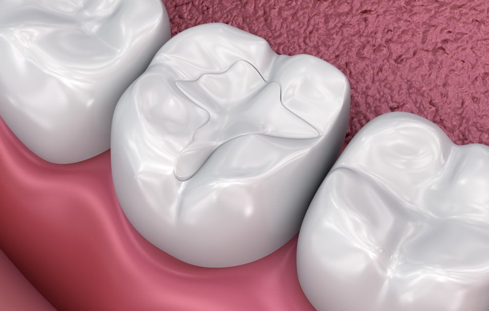 dental fillings in Kitchener