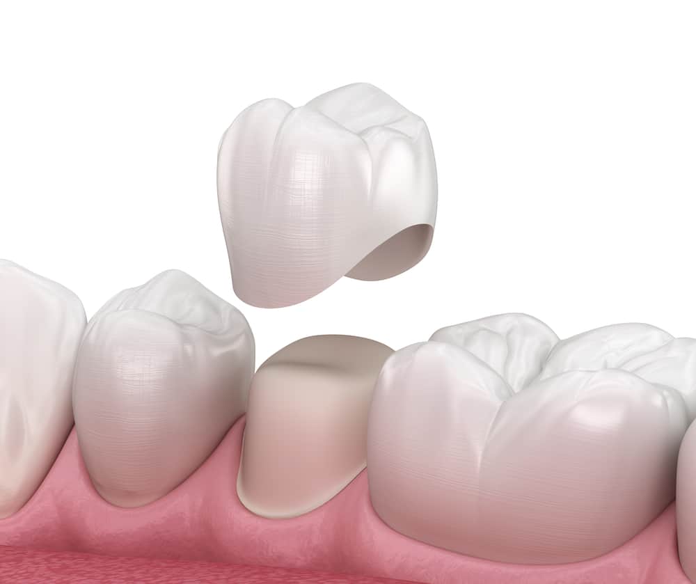 dental crown in Kitchener