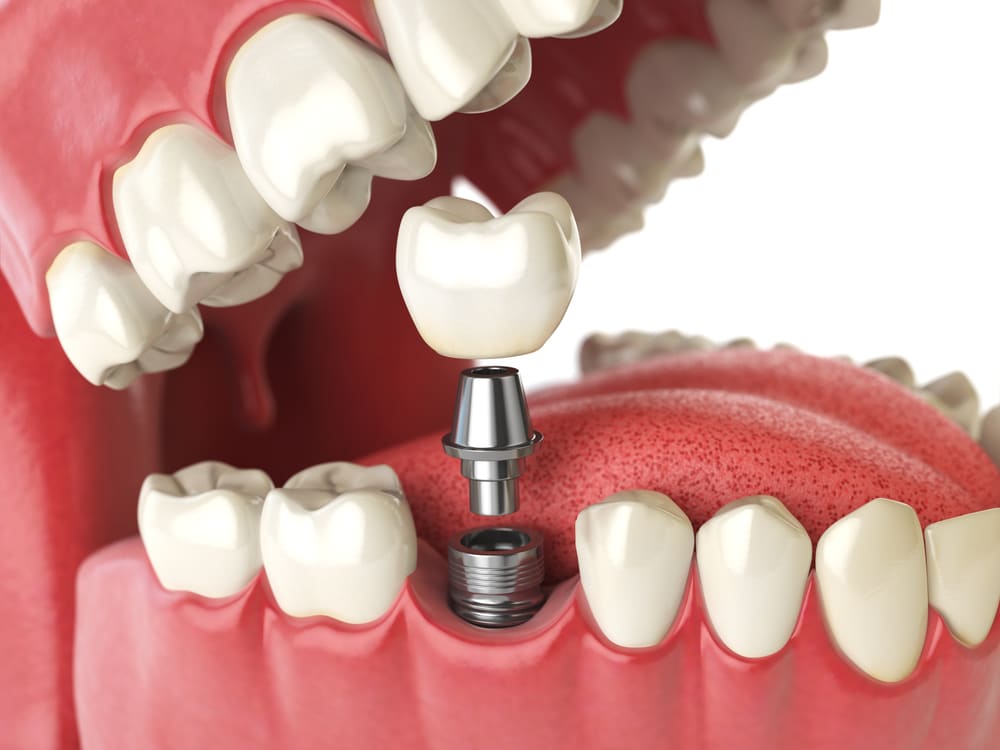 Dental Implants in Kitchener