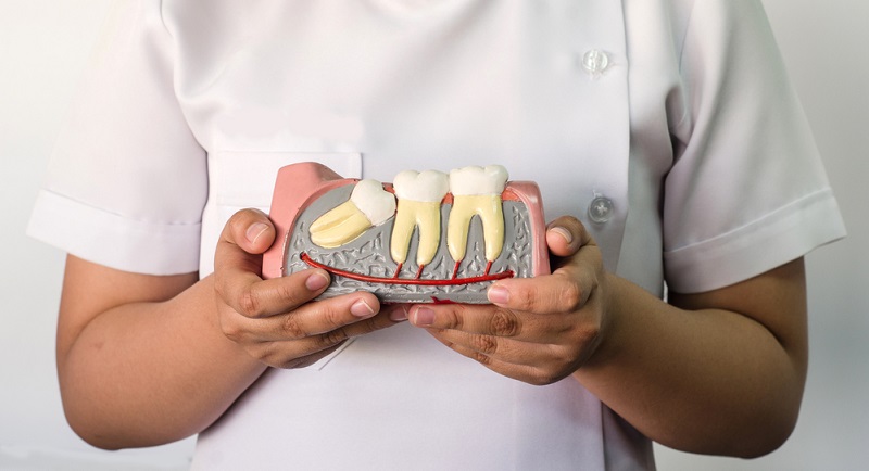 Person holding a dental model showing an impacted wisdom tooth beneath the gums next to surrounding teeth.