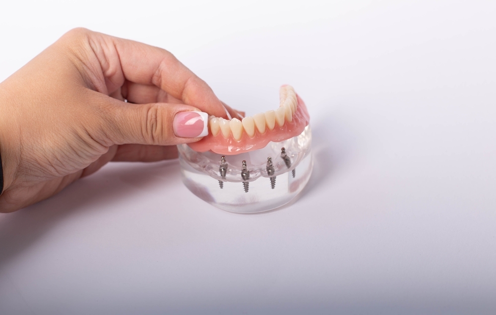 Demonstration model of an All-on-4 dental implant system showing a full-arch prosthesis supported by four strategically placed implants.