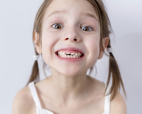 Young child smiling and showing baby teeth, highlighting the importance of caring for primary teeth during early childhood.